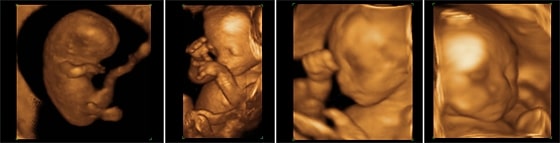 超音波健診による胎児の画像